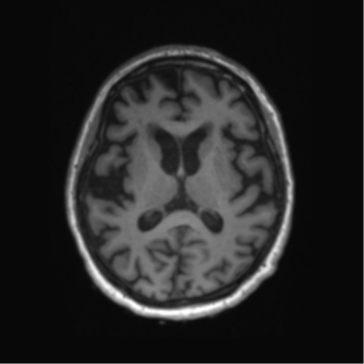 Behavioral variant frontotemporal dementia and late onset schizophrenia (Radiopaedia 52197-58083 Axial T1 45).png