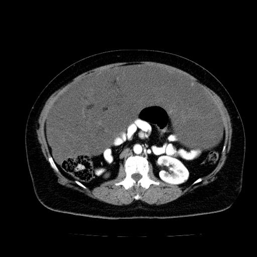 File:Benign spindle cell tumor - abdominopelvic (Radiopaedia 61300-69212 A 28).jpg