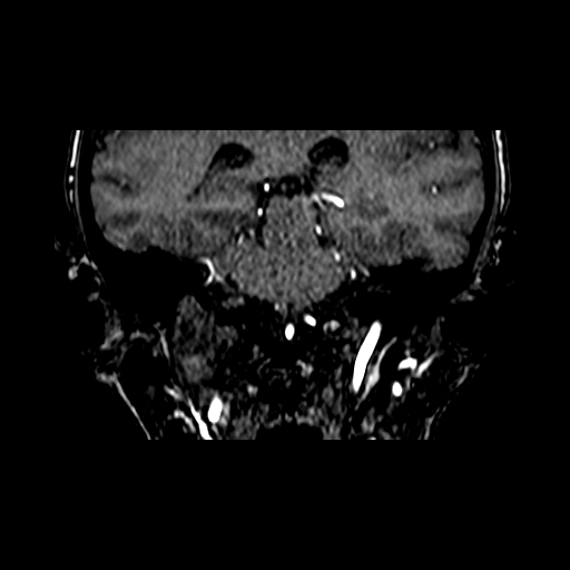 File:Berry aneurysm of the terminal internal carotid artery (Radiopaedia 88286-104918 Coronal TOF 66).jpg