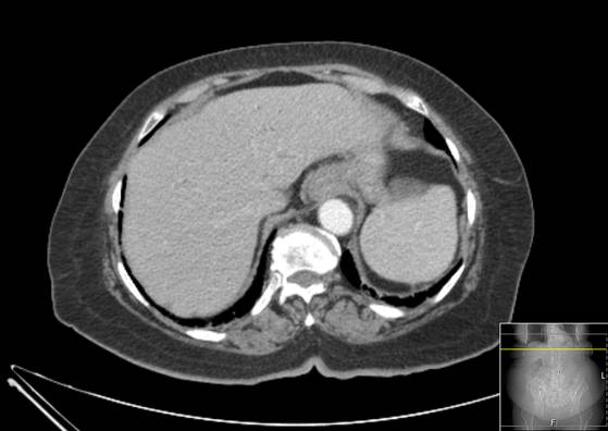 Bicameral celiacomesenteric aneurysm (Radiopaedia 55766-62327 A 8).jpg