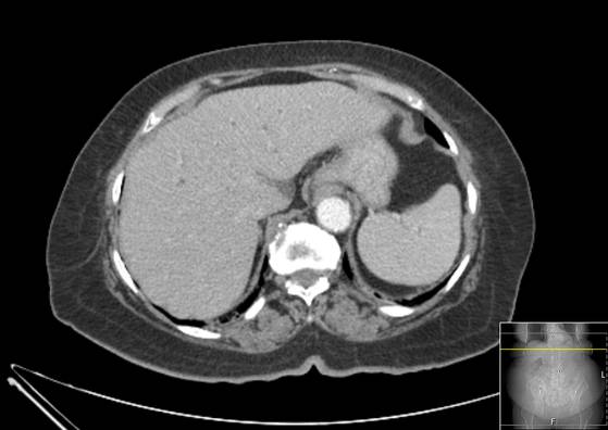 Bicameral celiacomesenteric aneurysm (Radiopaedia 55766-62327 A 9).jpg