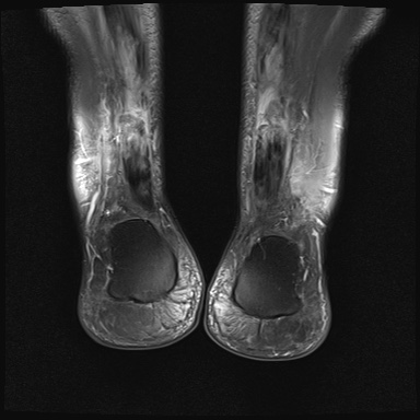 File:Bilateral Achilles tendon complete tear (Radiopaedia 81344-95051 Coronal PD fat sat 1).jpg