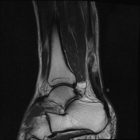 File:Bilateral Achilles tendon complete tear (Radiopaedia 81344-95051 Sagittal T2 7).jpg