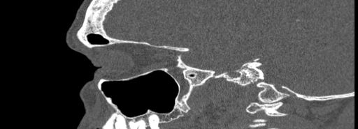 Bilateral Ectopic Infraorbital Nerves (Radiopaedia 49006-54084 Sagittal bone window 36).jpg
