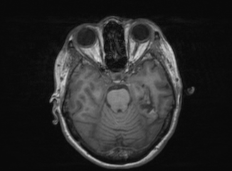 Bilateral PCA territory infarction - different ages (Radiopaedia 46200-51784 Axial T1 280).jpg