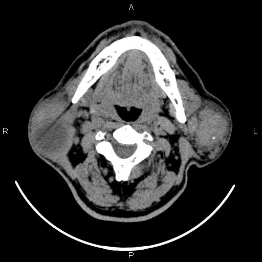 Bilateral Warthin tumors (Radiopaedia 84034-99263 Axial non-contrast 26).jpg
