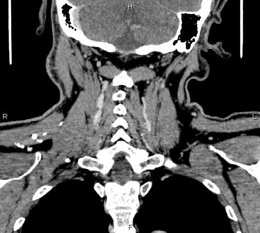 File:Bilateral Warthin tumors (Radiopaedia 84034-99263 C 40).jpg