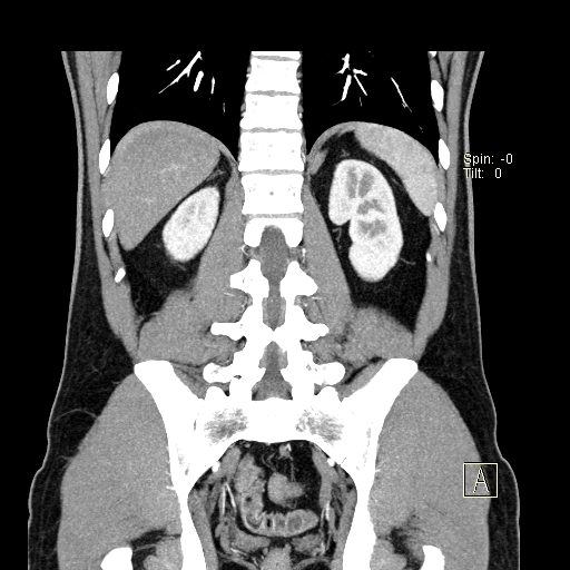 File:Bilateral accessory renal arteries with mild pelvi-ureteric junction (PUJ) obstruction (Radiopaedia 66357-75596 B 44).jpg