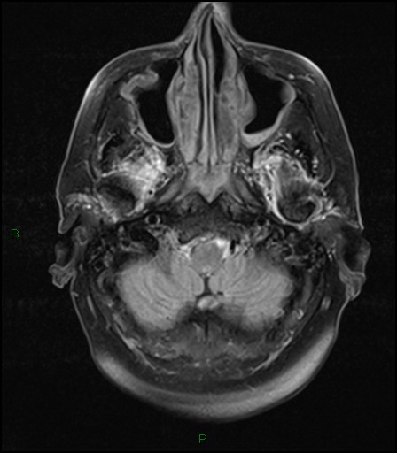 File:Bilateral acute middle cerebral artery territory infarcts (Radiopaedia 77319-89402 Axial FLAIR 4).jpg