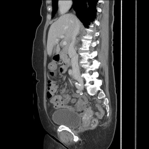 Bilateral adrenal granulocytic sarcomas (chloromas) (Radiopaedia 78375-91007 C 64).jpg