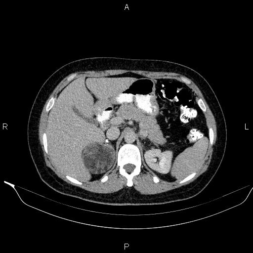 Bilateral adrenal myelolipoma (Radiopaedia 63058-71535 Axial C+ delayed 25).jpg