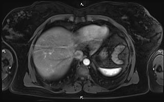 Bilateral adrenal myelolipoma (Radiopaedia 63058-71537 Axial T1 C+ fat sat 14).jpg