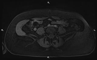Bilateral adrenal myelolipoma (Radiopaedia 63058-71537 Axial T1 C+ fat sat 78).jpg