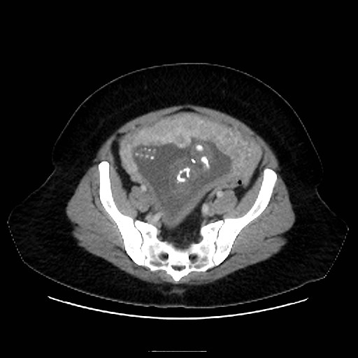 Bilateral adrenal thrombosis (Radiopaedia 58182-65256 A 61).jpg