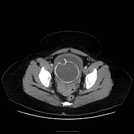 Bilateral adrenal thrombosis (Radiopaedia 58182-65256 A 70).jpg