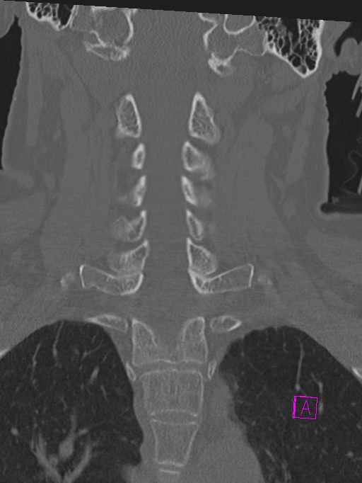 Bilateral atlanto-occipital assimilation (Radiopaedia 28350-28603 Coronal bone window 24).jpg