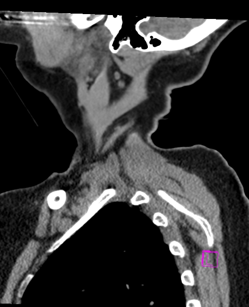 Bilateral atlanto-occipital assimilation (Radiopaedia 28350-28603 D 6).jpg