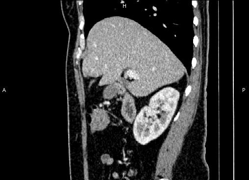 Bilateral benign adrenal adenomas (Radiopaedia 86912-103124 E 30).jpg
