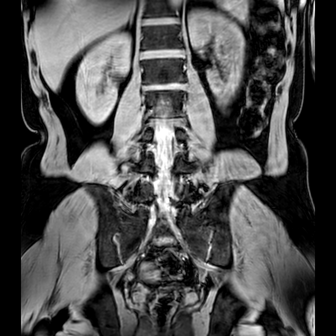 Bilateral conjoined nerve roots at different levels (Radiopaedia 73312-84063 Coronal WE 31).jpg