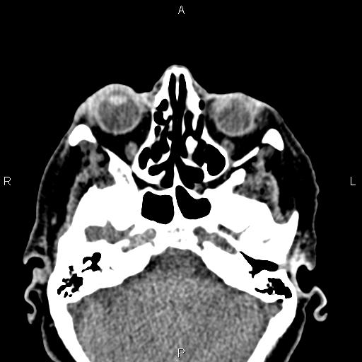 Bilateral enlargement of lacrimal glands - sarcoidosis (Radiopaedia 62627-70921 Axial non-contrast 32).jpg