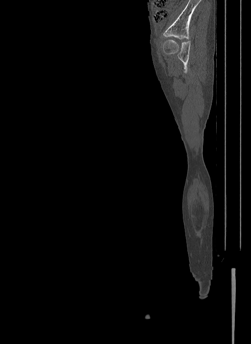 Bilateral fibular hemimelia type II (Radiopaedia 69581-79491 Sagittal bone window 33).jpg