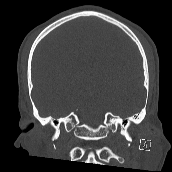 Bilateral occipital condyle fracture (type 2) (Radiopaedia 87675-104089 Coronal bone window 70).jpg
