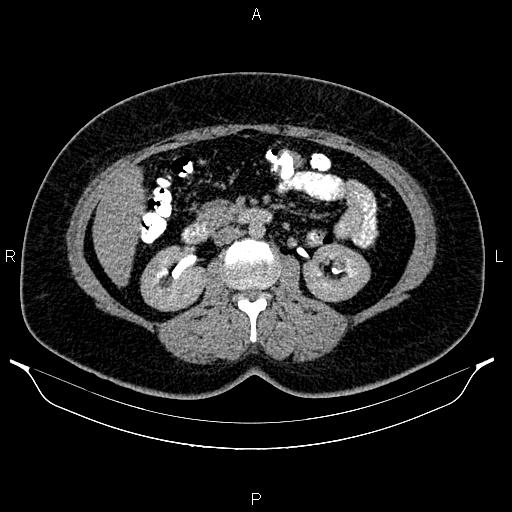 Bilateral ovarian dermoid cysts (Radiopaedia 85785-101603 Axial C+ delayed 31).jpg
