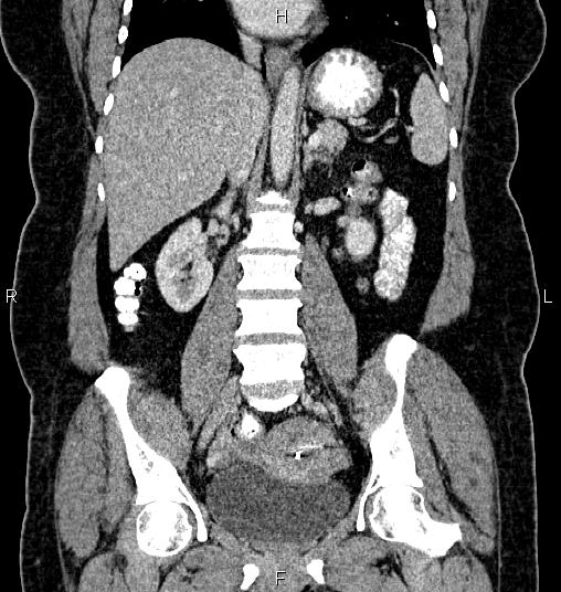 File:Bilateral ovarian dermoid cysts (Radiopaedia 85785-101603 C 32).jpg