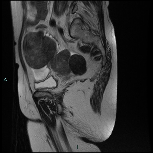 File:Bilateral ovarian fibroma (Radiopaedia 44568-48293 Sagittal T2 11).jpg
