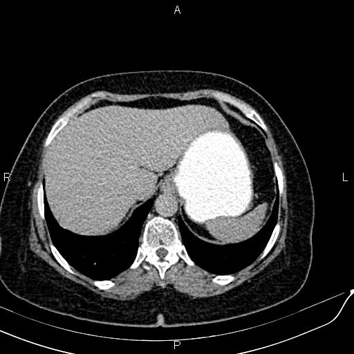 Bilateral ovarian serous cystadenocarcinoma (Radiopaedia 86062-101989 Axial C+ delayed 3).jpg