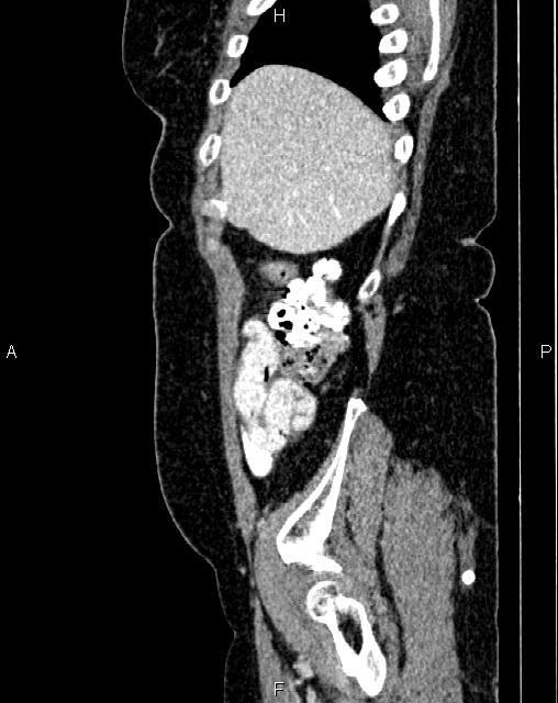 Bilateral ovarian serous cystadenocarcinoma (Radiopaedia 86062-101989 E 9).jpg