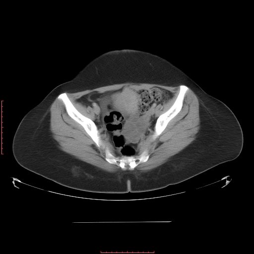 File:Bilateral ovarian serous cystadenocarcinoma with right ovarian torsion (Radiopaedia 32640-33611 A 36).jpg