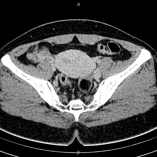 Bilateral ovarian teratoma (Radiopaedia 83131-97503 B 34).jpg