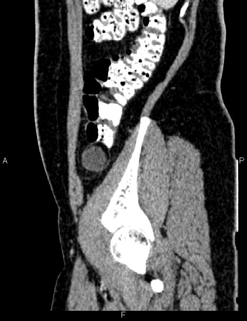 Bilateral ovarian teratoma (Radiopaedia 83131-97503 D 33).jpg