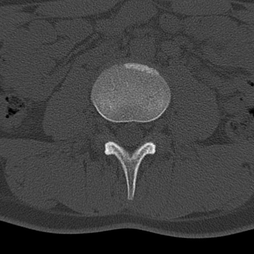 Bilateral pars defect (Radiopaedia 26691-26846 Axial bone window 9).jpg