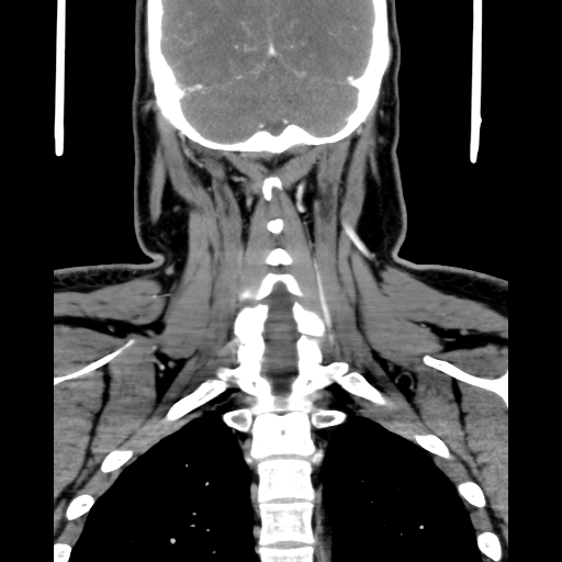 Bilateral peritonsillar abscess (Radiopaedia 85065-100610 Coronal 58).jpg