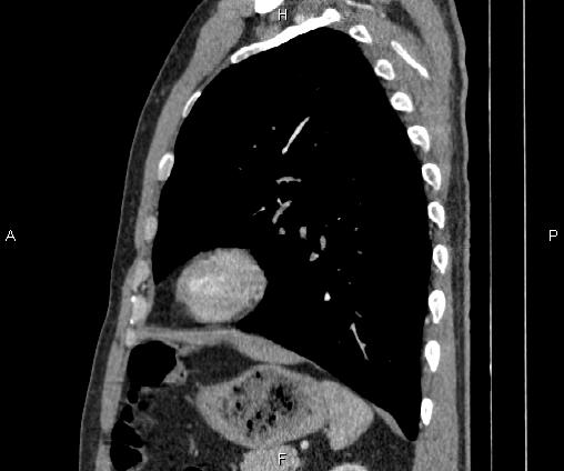Bilateral pulmonary AVM (Radiopaedia 83134-97505 D 81).jpg