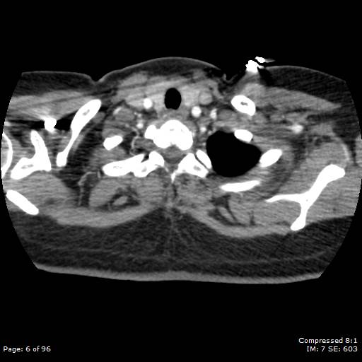 Bilateral pulmonary emboli with Hampton hump sign (Radiopaedia 54070-60246 Axial C+ CTPA 3).jpg