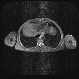 File:Bilateral spinoglenoid notch ganglion cysts (Radiopaedia 29577-30082 E 27).jpg