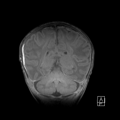 Bilateral subdural hemorrhage and parietal skull fracture (Radiopaedia 26058-26190 Coronal T1 36).png