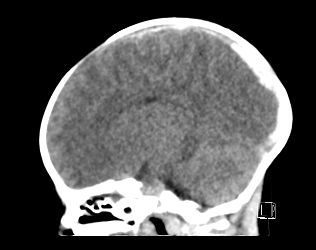 File:Bilateral subdural hemorrhage and parietal skull fracture (Radiopaedia 26058-26192 C 10).png