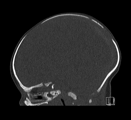 Bilateral subdural hemorrhage and parietal skull fracture (Radiopaedia 26058-26192 Sagittal bone window 42).png