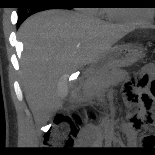 File:Bile leak from liver traumatic laceration (Radiopaedia 63463-72077 Coronal Biliscopin 13).jpg