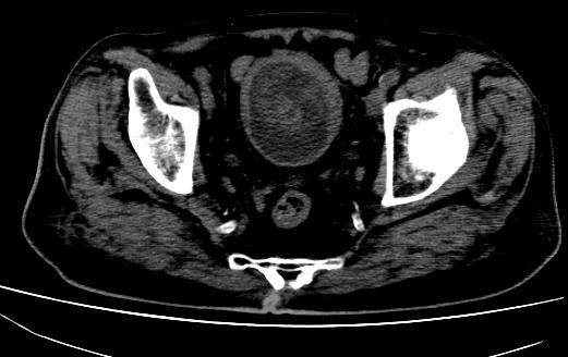 File:Bladder carcinoma (Radiopaedia 15813-15458 Axial non-contrast 1).JPG