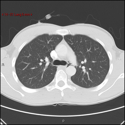 Blunt chest trauma - pulmonary interstitial emphysema and pneumomediastinum (Radiopaedia 20666-20552 Axial lung window 21).jpg