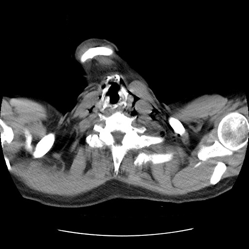 Boerhaave syndrome (Radiopaedia 59796-67310 Axial liver window 5).jpg