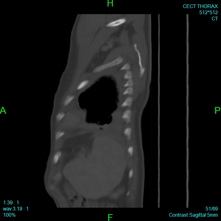 Bone metastases from lung carcinoma (Radiopaedia 54703-60937 Sagittal bone window 51).jpg