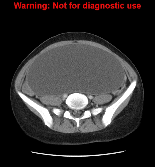 Borderline mucinous cystadenoma of ovary (Radiopaedia 25586-25767 A 64).jpg