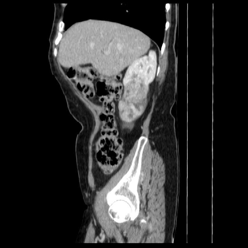 Bosniak renal cyst - type IV (Radiopaedia 22929-22953 G 17).jpg