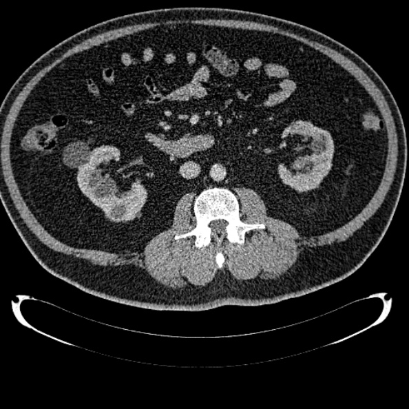 File:Bosniak renal cyst - type IV (Radiopaedia 24244-24518 C 183).jpg